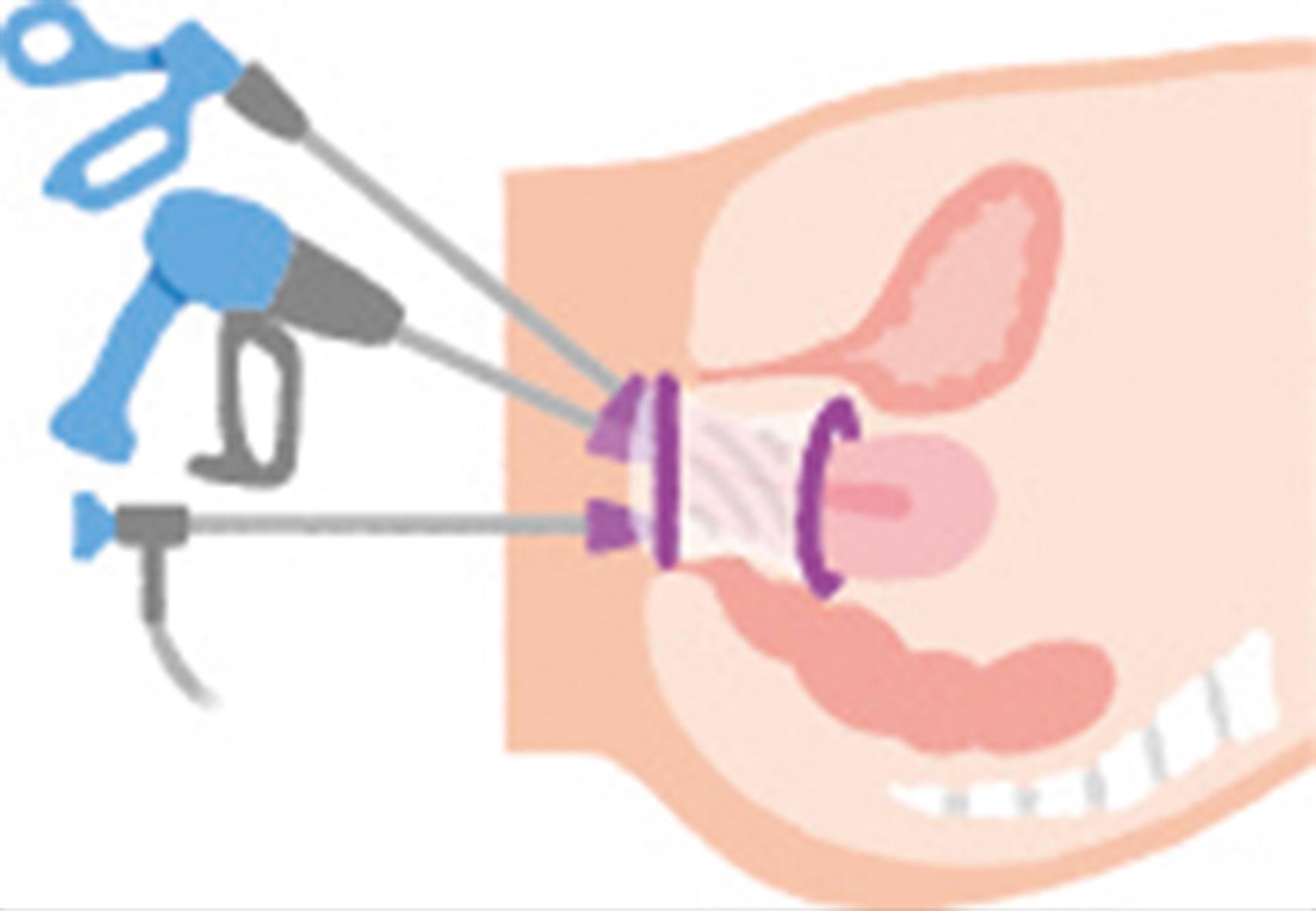 図｜vNOTES（経腟内視鏡手術）の模式図