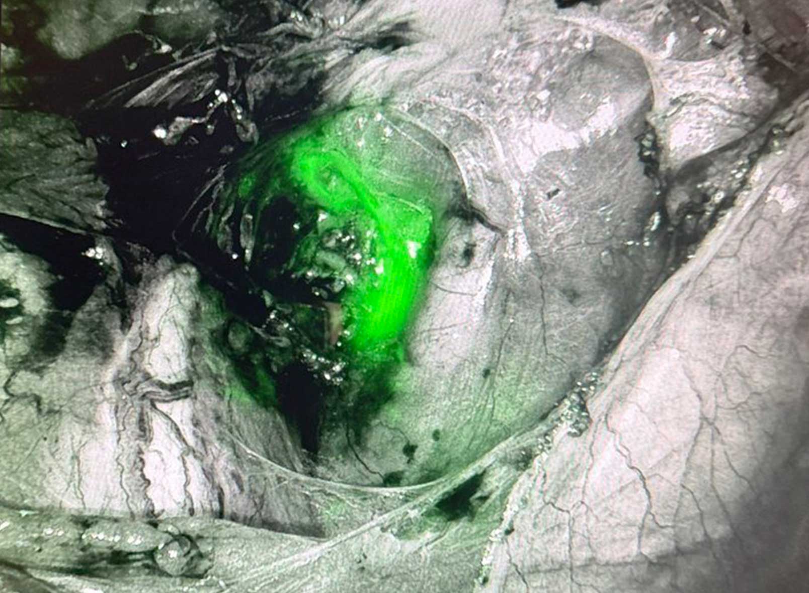 蛍光法で描出されたセンチネルリンパ節（緑色）